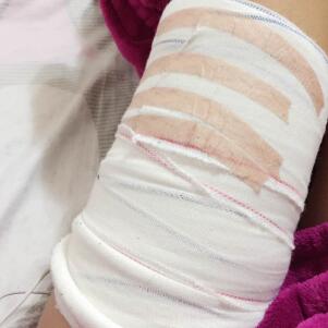 吸脂減肥瘦手臂，甩掉蝴蝶袖告別粗手臂真實(shí)案例分享