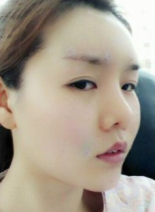 陳萬芳醫(yī)生做的自體脂肪填充面部后變得超年輕