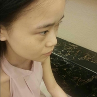 自體脂肪隆鼻之后恢復得很好果超自然的