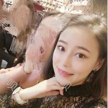 自體脂肪隆鼻之后恢復得很好果超自然的