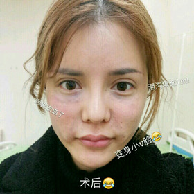 埋蛋白線.提升面部對比圖片，顏值嘩嘩嘩的往上漲!!!