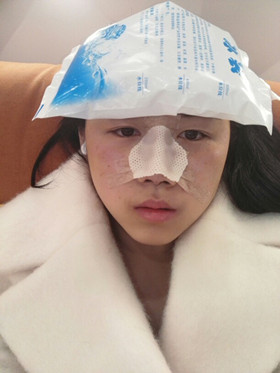 于立民醫(yī)生給我做的隆鼻整形手術(shù)，給大家分享我整形的過程吧!