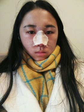 于立民醫(yī)生給我做的隆鼻整形手術(shù)，給大家分享我整形的過程吧!