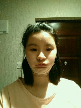 自體脂肪填充下巴前后對比圖，進來看看就知道啦!