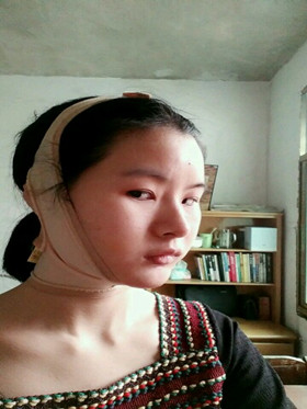 自體脂肪填充下巴前后對比圖，進來看看就知道啦!