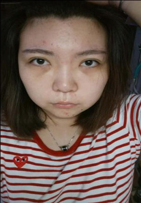 激光去眼袋后，整個(gè)人都年輕了不少啊!