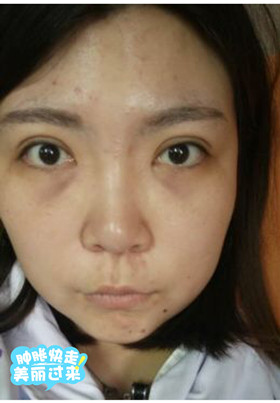 激光去眼袋后，整個(gè)人都年輕了不少啊!