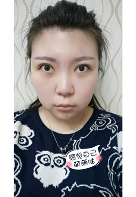 激光去眼袋后，整個(gè)人都年輕了不少啊!