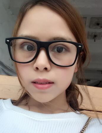 切開(kāi)雙眼皮恢復(fù)過(guò)程 心路分享~