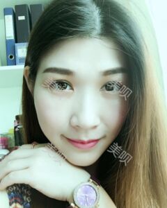 在廣州締妍做了內(nèi)切去眼袋后年輕多了