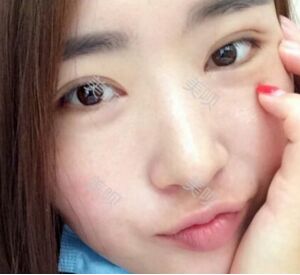 煙臺鵬愛做的雙眼皮宛如天生