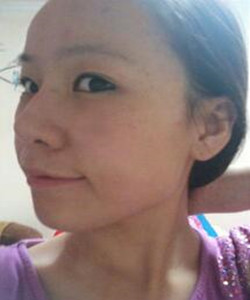 北京301醫(yī)院做下頜角整形果對(duì)比圖開來圍觀啊