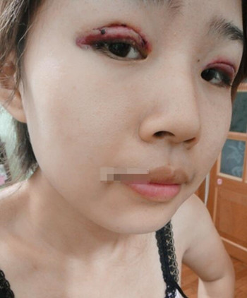 你們來看看藝美門智和做的埋線雙眼皮，瞬間變大眼美女