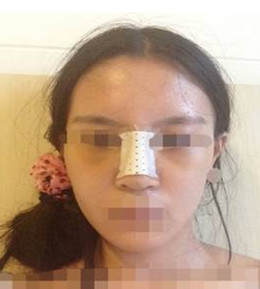 藝美門智和綜合隆鼻，你值得擁有