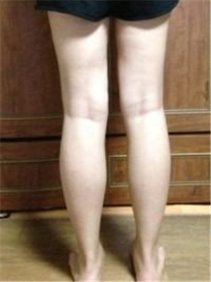 大腿吸脂后的長(zhǎng)腿美女就是我