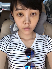 開外眼角手術(shù)前后過程對比圖片