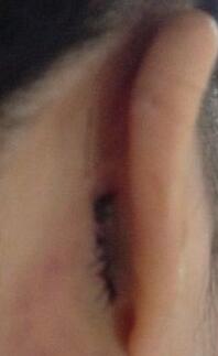 耳軟骨隆鼻前后過程圖片，見證我變美的過程