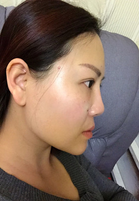 自體脂肪填充面部前后對比圖片，真的美了美了!