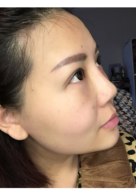 自體脂肪填充面部前后對比圖片，真的美了美了!