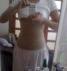 北京禾美嘉腹部吸脂 可以自信地秀出小蠻腰啦！