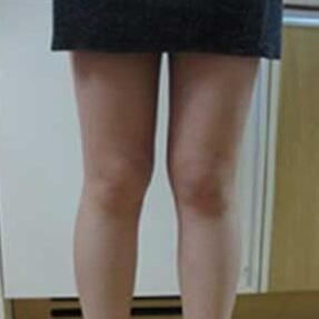 北京禾美嘉大腿吸脂 給大家分享一下體驗(yàn)