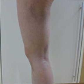 北京禾美嘉大腿吸脂 給大家分享一下體驗(yàn)