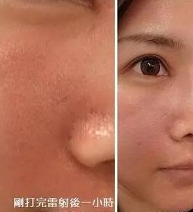 成都玉之光激光嫩膚經(jīng)歷 愛美的MM一定要看