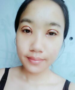 煙臺(tái)鵬愛(ài)魏璐做的全切雙眼皮，我也是大眼美女了