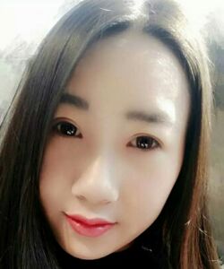 煙臺(tái)鵬愛(ài)魏璐做的全切雙眼皮，我也是大眼美女了