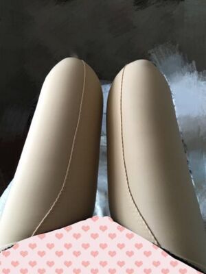 擺脫大粗腿做了大腿抽脂，煙臺(tái)鵬愛(ài)魏璐做的