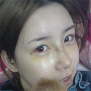 百*麗沈國(guó)雄做的隆鼻失敗修復(fù)，恢復(fù)果很好，還有前后對(duì)比照片！