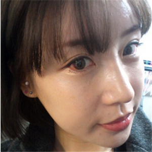 百*麗沈國(guó)雄做的隆鼻失敗修復(fù)，恢復(fù)果很好，還有前后對(duì)比照片！