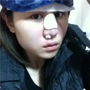 百*麗徐曉斐做的膨體假體隆鼻，給你們看看前后對比果圖片~