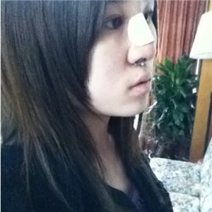 百*麗徐曉斐做的膨體假體隆鼻，給你們看看前后對比果圖片~