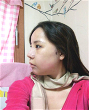 下頜角整形做完變小臉 孫麗君醫(yī)生棒棒噠