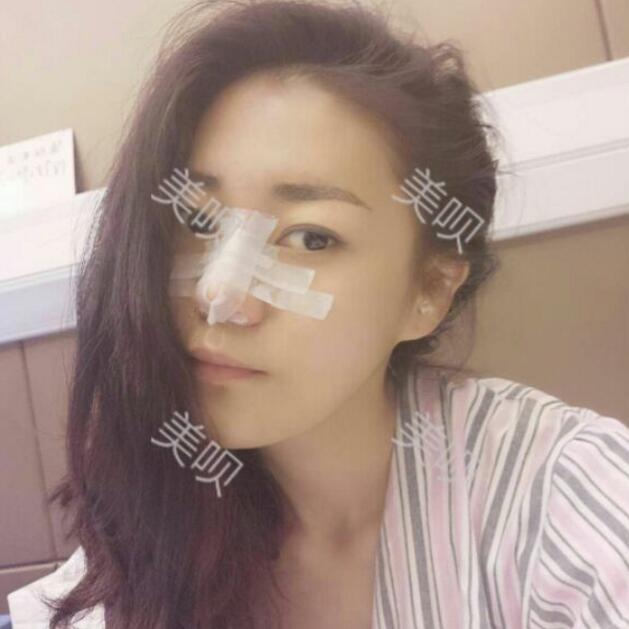 自體脂肪隆鼻+割雙眼皮恢復(fù)后的果我很滿意