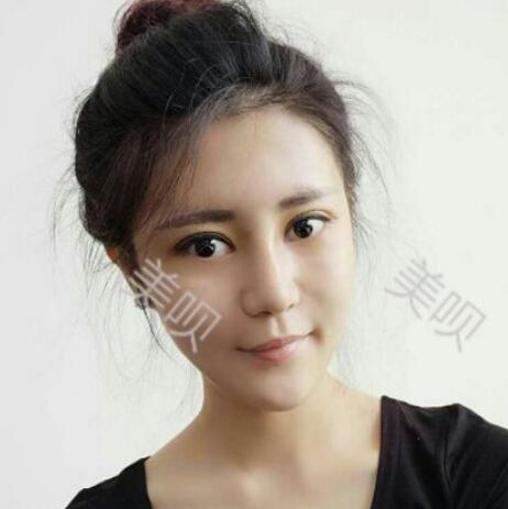 自體脂肪隆鼻+割雙眼皮恢復(fù)后的果我很滿意