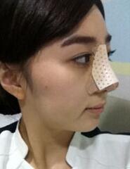 深圳希思崔院長(zhǎng)隆鼻整形 擺脫了豬妹妹的稱號(hào)