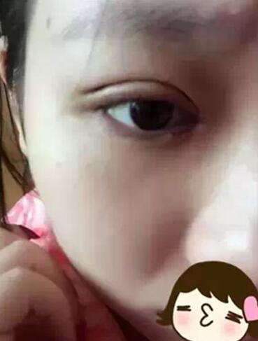 深圳希思做的雙眼皮+開眼角 感謝楊醫(yī)師！