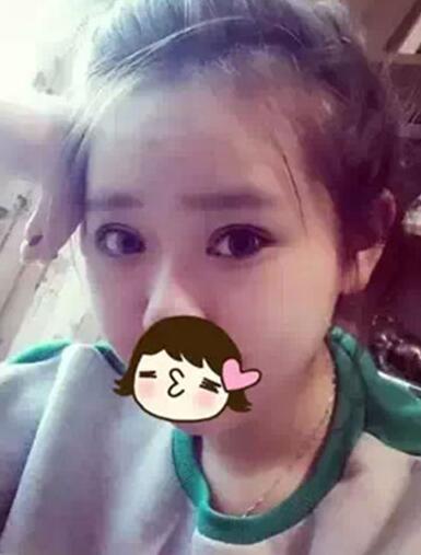 深圳希思做的雙眼皮+開眼角 感謝楊醫(yī)師！