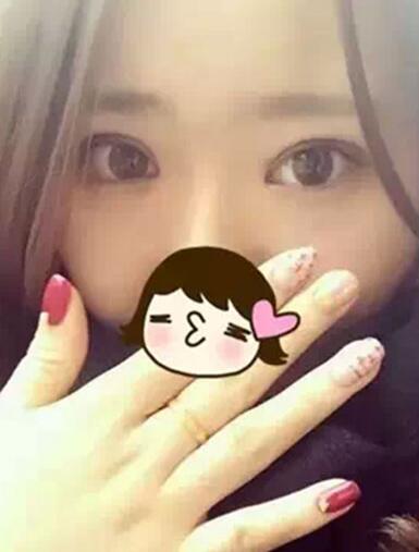 深圳希思做的雙眼皮+開眼角 感謝楊醫(yī)師！