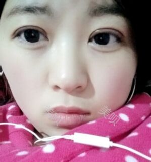 合肥壹加壹王大勇做的切開雙眼皮分享給大家