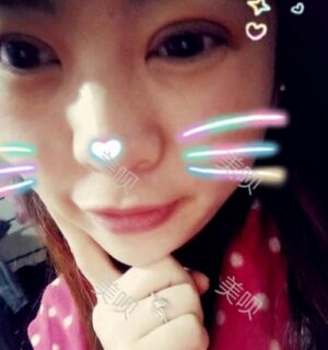 合肥壹加壹王大勇做的切開雙眼皮分享給大家