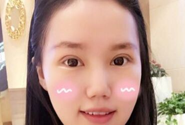 雙眼皮讓我眼睛變得更大更漂亮啦