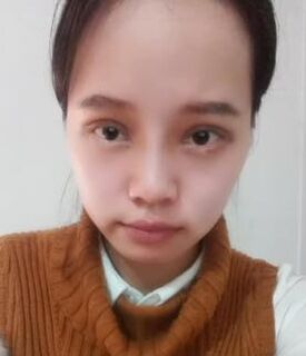 全切雙眼皮+去脂肪，終于擺脫小眼睛了