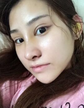 硅膠隆鼻還墊鼻尖了，甘泉涌做的果真的很好喲