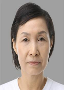 做了電波l皮除皺年輕了十多歲 杭州同欣做的很不錯哦