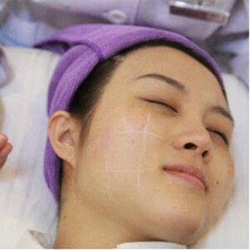 做了高強度聚焦超聲除皺小細紋都沒有啦 大家快來圍觀啊