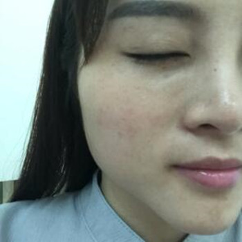 做了高強度聚焦超聲除皺小細紋都沒有啦 大家快來圍觀啊