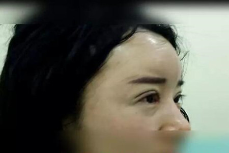成都天使之翼做的雙眼皮修復怎么樣 快來圍觀